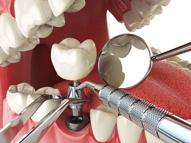 Best Emergency Broken Tooth Repair in Juneau, WI